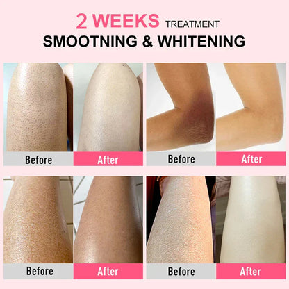 Body Cream Chicken Skin Removal Treatment Keratosis Pilaris Lotion Bumpy Rough Pore Spots Care Moisturizer Whitening Creams 60g